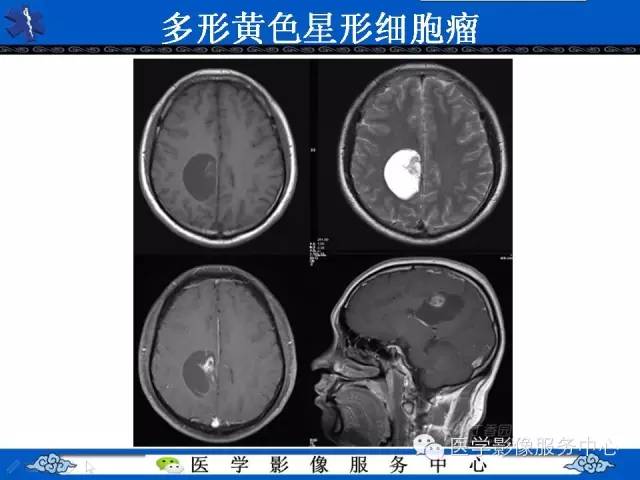 【病例】毛细胞型星形细胞瘤1例MR影像表现