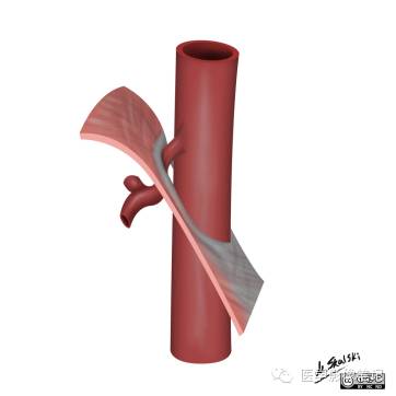 中弓状韧带压迫综合征 中弓状韧带压迫综合征