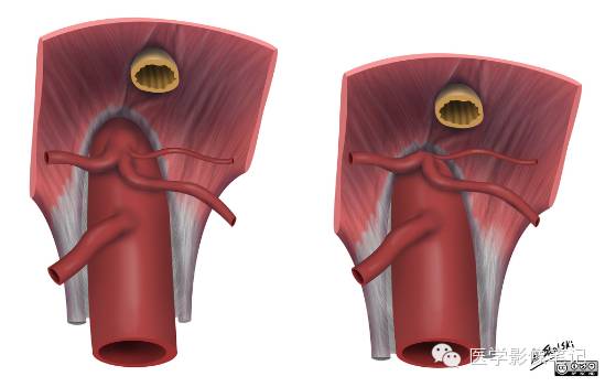 中弓状韧带压迫综合征 中弓状韧带压迫综合征