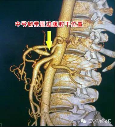中弓状韧带压迫综合征 中弓状韧带压迫综合征