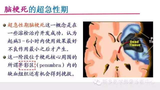 脑梗塞的磁共振分期图解