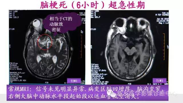 脑梗塞的磁共振分期图解