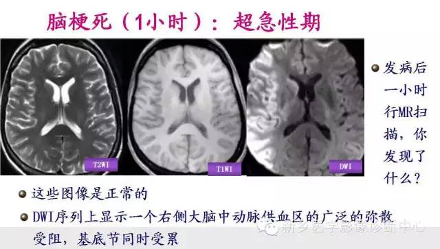脑梗塞的磁共振分期图解