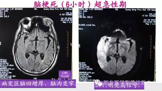 脑梗塞的磁共振分期图解