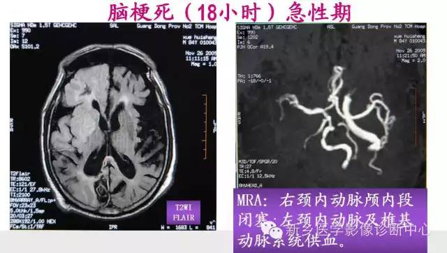 脑梗塞的磁共振分期图解