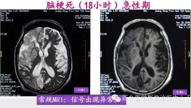 脑梗塞的磁共振分期图解