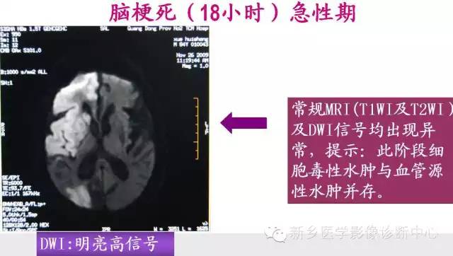 脑梗塞的磁共振分期图解