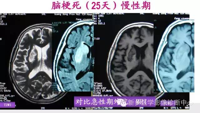 脑梗塞的磁共振分期图解