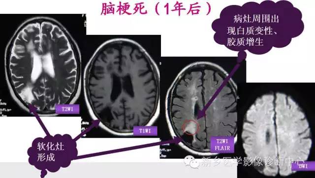 脑梗塞的磁共振分期图解