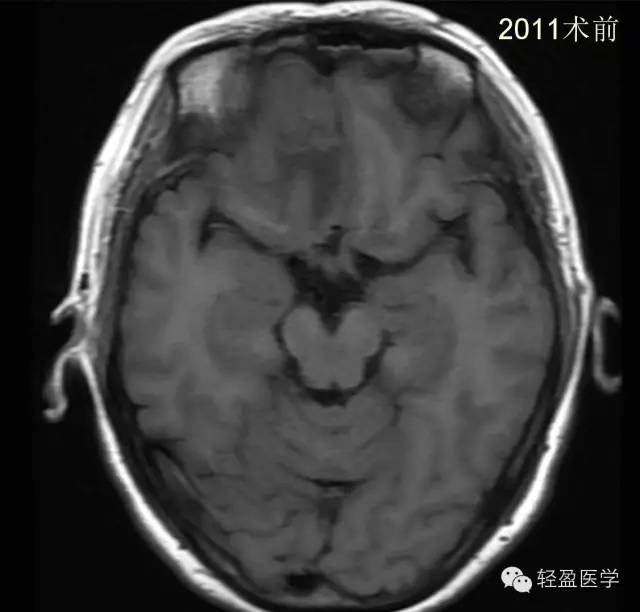 【病例】颅内肿瘤，脑内？脑外？