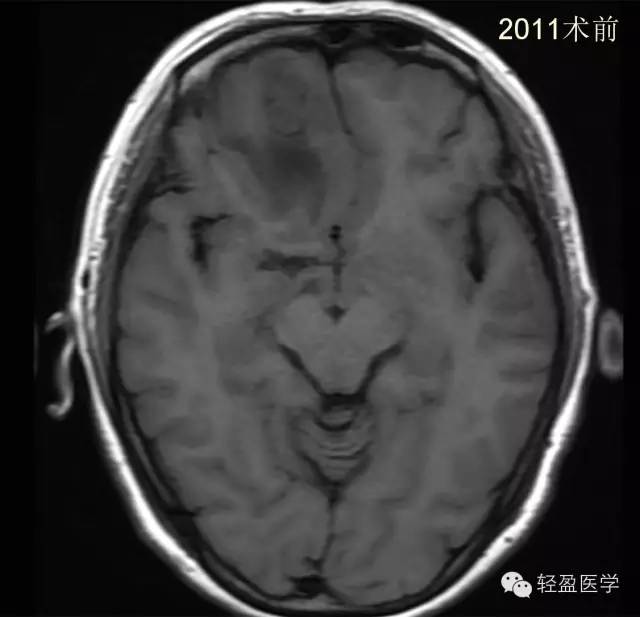 【病例】颅内肿瘤，脑内？脑外？