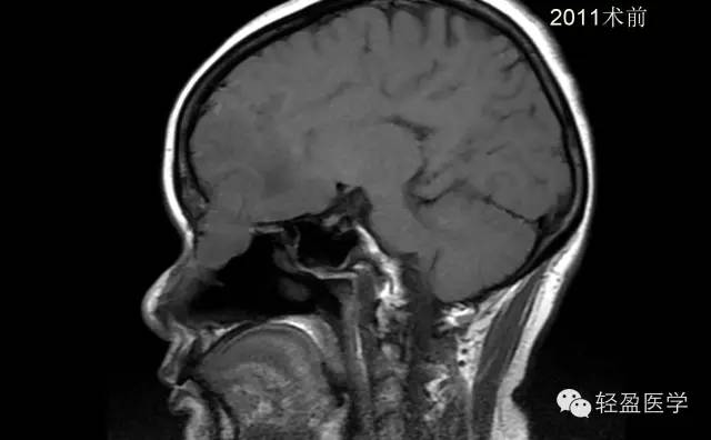 【病例】颅内肿瘤，脑内？脑外？
