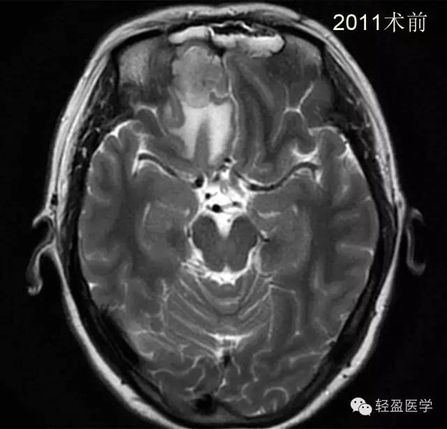 【病例】颅内肿瘤，脑内？脑外？