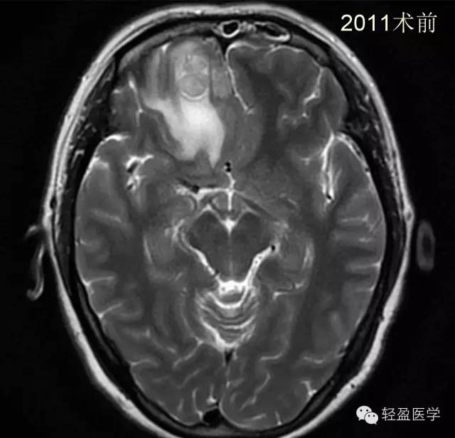 【病例】颅内肿瘤，脑内？脑外？