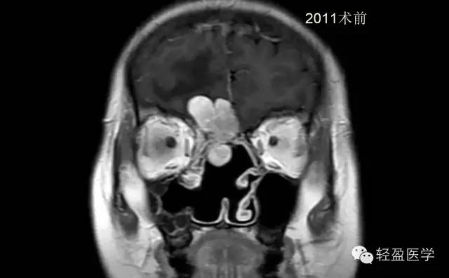 【病例】颅内肿瘤，脑内？脑外？