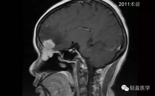 【病例】颅内肿瘤，脑内？脑外？
