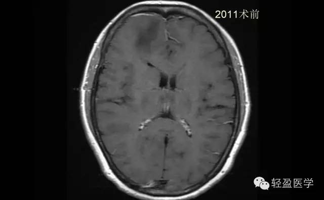 【病例】颅内肿瘤，脑内？脑外？