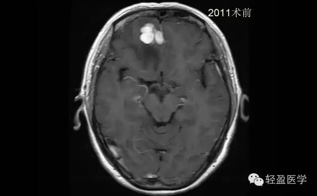 【病例】颅内肿瘤，脑内？脑外？