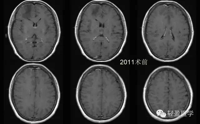 【病例】颅内肿瘤，脑内？脑外？