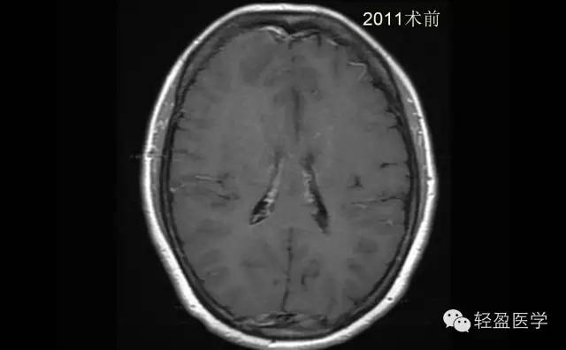【病例】颅内肿瘤，脑内？脑外？