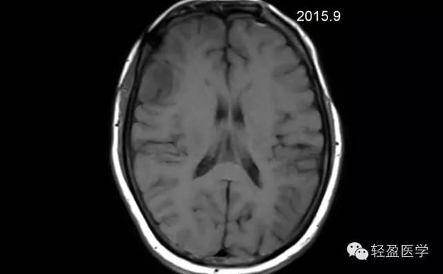 【病例】颅内肿瘤，脑内？脑外？