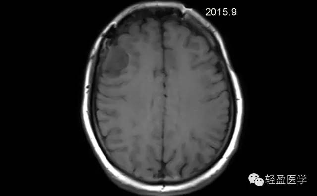 【病例】颅内肿瘤，脑内？脑外？