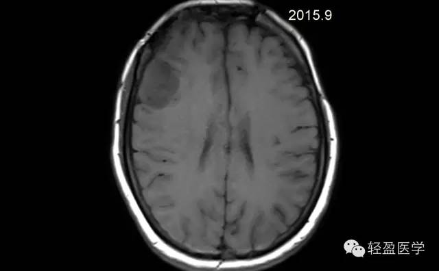 【病例】颅内肿瘤，脑内？脑外？