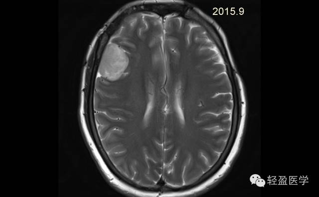 【病例】颅内肿瘤，脑内？脑外？