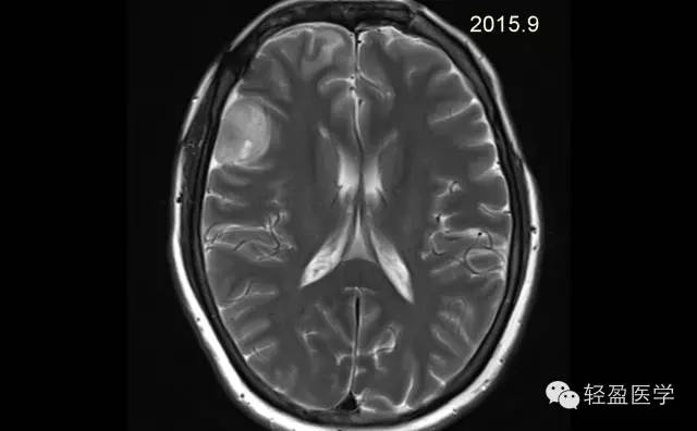 【病例】颅内肿瘤，脑内？脑外？