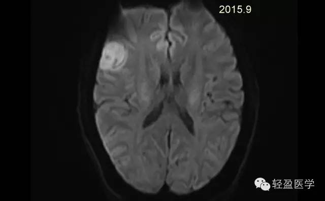 【病例】颅内肿瘤，脑内？脑外？
