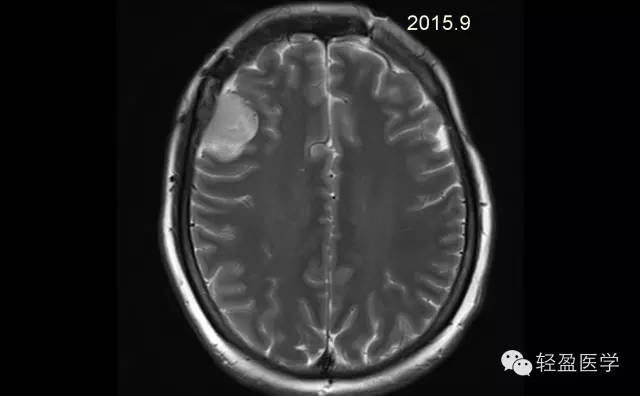【病例】颅内肿瘤，脑内？脑外？