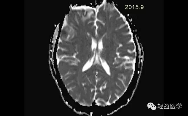 【病例】颅内肿瘤，脑内？脑外？