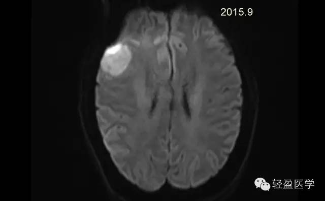 【病例】颅内肿瘤，脑内？脑外？