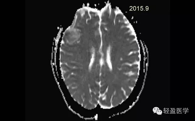 【病例】颅内肿瘤，脑内？脑外？