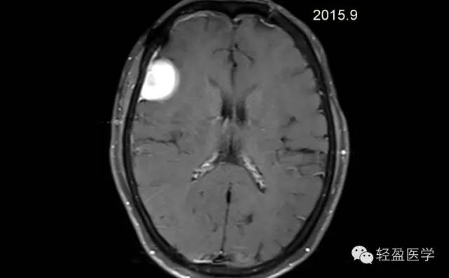【病例】颅内肿瘤，脑内？脑外？