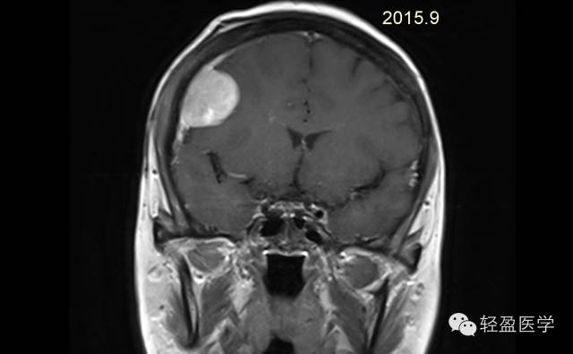 【病例】颅内肿瘤，脑内？脑外？
