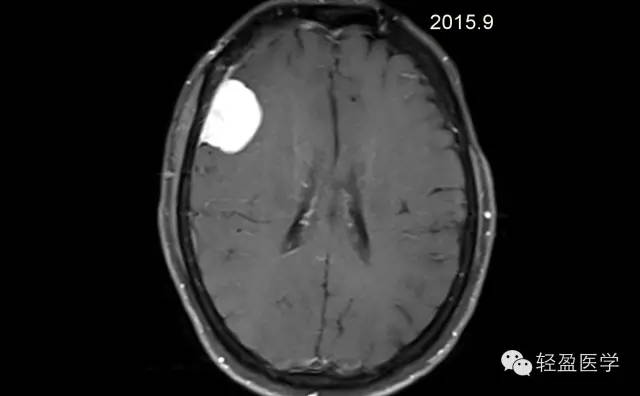 【病例】颅内肿瘤，脑内？脑外？