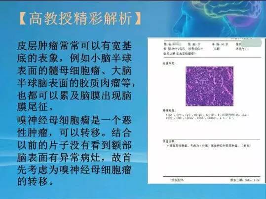 【病例】颅内肿瘤，脑内？脑外？