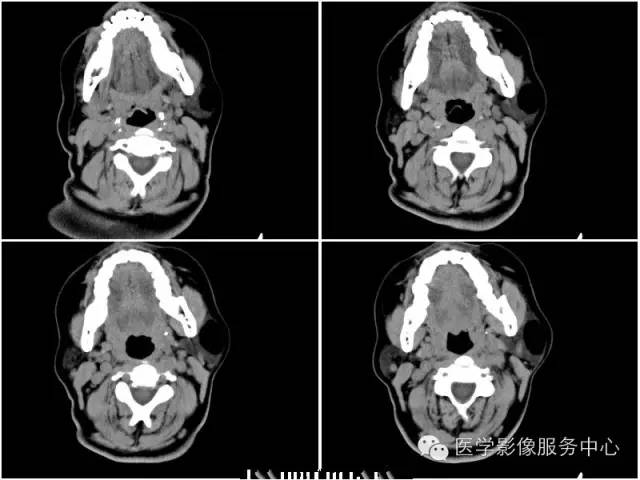 【病例】腮腺脂肪瘤1例CT影像表现
