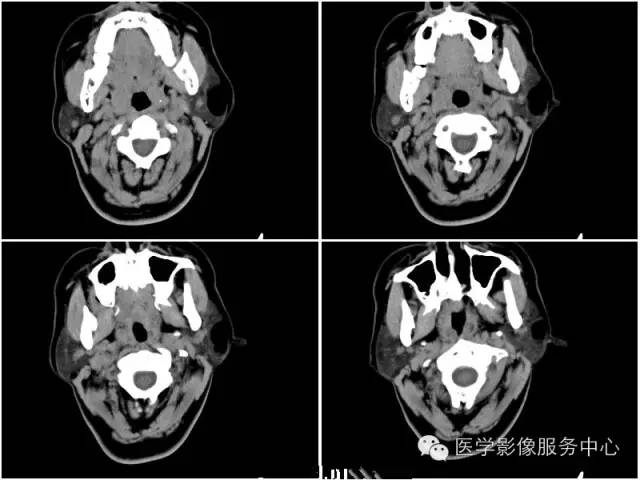 【病例】腮腺脂肪瘤1例CT影像表现