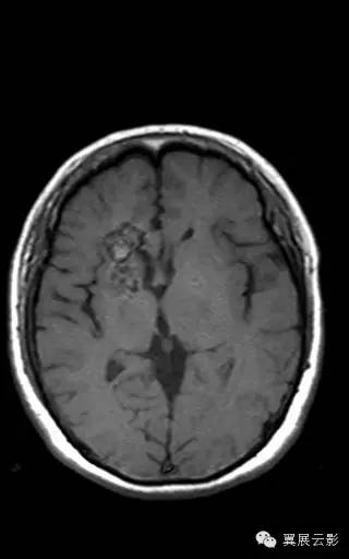 【病例】右侧基底节区海绵状血管瘤1例MR影像表现