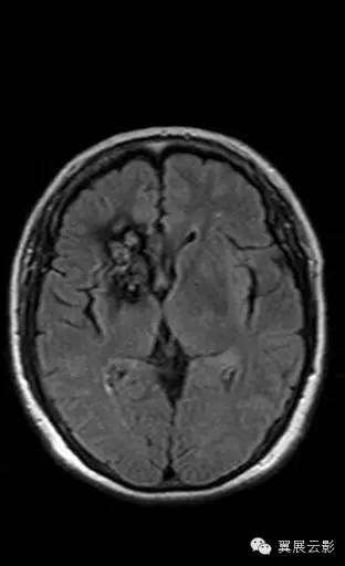 【病例】右侧基底节区海绵状血管瘤1例MR影像表现