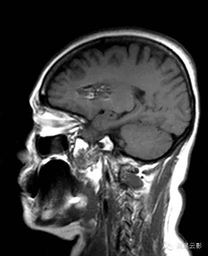 【病例】右侧基底节区海绵状血管瘤1例MR影像表现