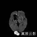 【病例】右侧基底节区海绵状血管瘤1例MR影像表现