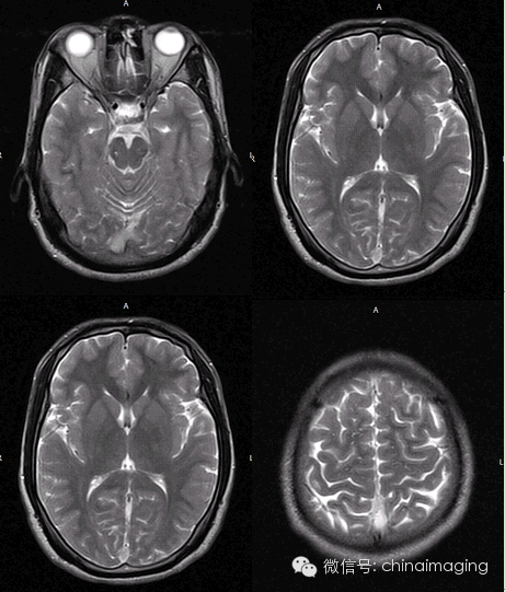 【病例】脑静脉窦血栓一例影像表现 【病例】脑静脉窦血栓一例影像表现