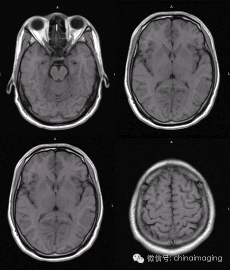 【病例】脑静脉窦血栓一例影像表现