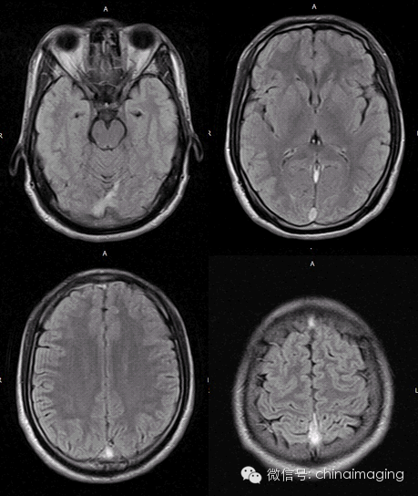 【病例】脑静脉窦血栓一例影像表现 【病例】脑静脉窦血栓一例影像表现