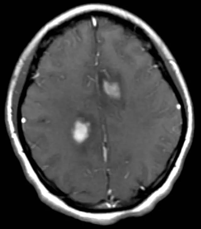 【病例】多发性硬化1例CT及MR影像表现