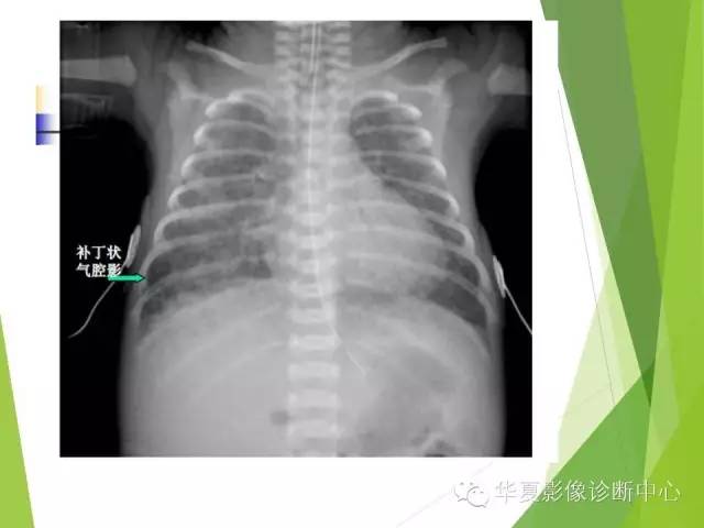 【PPT】新生儿常见的胸部病变