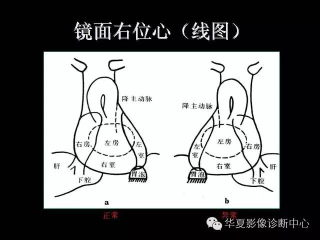 【PPT】先天性心脏病的影像学改变